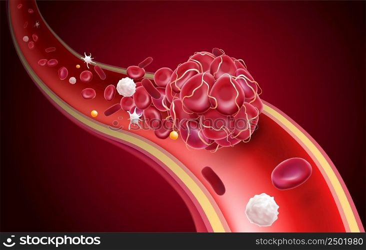 3D illustration of a blood clot in a blood vessel showing a blocked blood flow with platelets and white blood cells in the image. medical use education and science