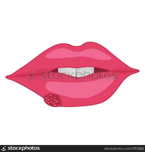 A mouth with a Cold sores on lips vector illustration on a white background isolated Health care concept viral contageous infection