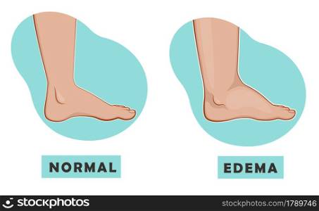 A swollen foot and ankle and a normal foot. Vector illustration of the disease. A swollen foot and ankle and a normal foot. Vector illustration