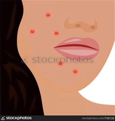 A young woman having acne infection problem skin concept vector illustration