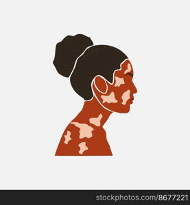 Abstract silhouette of beauty black skin woman with white pigmentation. Support awareness about chronic skin disorder. World Vitiligo day. Diversity tolerance. Fashion paper cut vector illustration