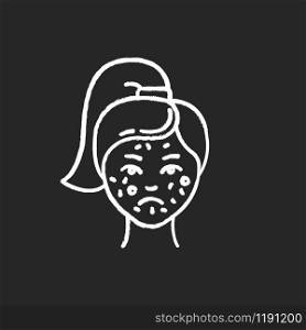 Acne chalk icon. Pimples on female face. Skincare for inflammation and irritation. Facial treatment. Puberty and teenager health problem. Dermatology. Isolated vector chalkboard illustration