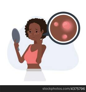 Acne concept.pimples. skin problems. African american woman is worried about her face getting acne. Flat vector cartoon character illustration.