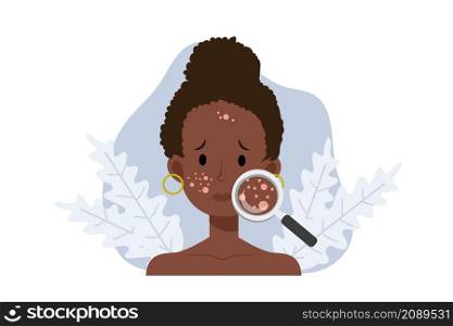 Acne skin problems Concept.African american woman with magnifying glass is looking acne on his facial. Falt vector cartoon illustration.