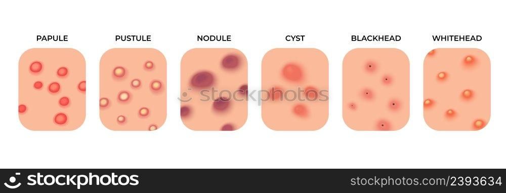 Acne types. Facial infections, pimples and skin inflammation. Skincare, face acne breakout. Dermatology epidermis disease recent vector set. Illustration of skin facial pustule and treatment. Acne types. Facial infections, pimples and skin inflammation. Skincare, face acne breakout. Dermatology epidermis disease recent vector set