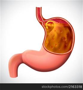 An illustration of a gastric reflux, dissected to show the inside, for medical and educational use.