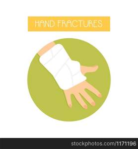 Anatomical vector illustration of a fractured hand with a cast. Sport injuries. Illustration of a fractured hand with a cast.