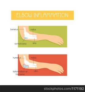 Anatomical vector illustration of elbow inflammation . Sport injuries concept. Poster with an elbow inflammation injuries concept