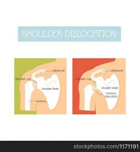 Anatomical vector illustration of shoulder dislocation. Sport injuries concept. Illustration of a healthy shoulder and dislocation
