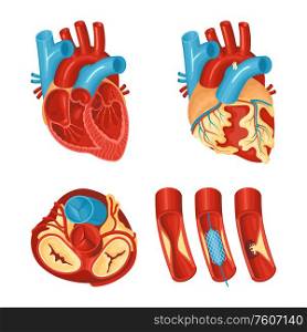 Anatomy of healthy and diseased heart flat set isolated on white background vector illustration