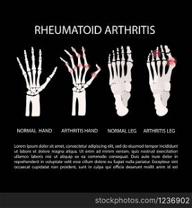 ARTHRITIS HAND LEG Rheumatoid Medicine Education Vector Scheme