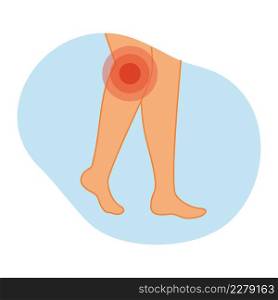 Arthritis of the knee joint. Vector illustration of legs with inflammation in the knee area. Diseases of the musculoskeletal system.
