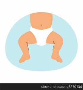 Baby in diaper. Hip dysplasia. Vector illustration.