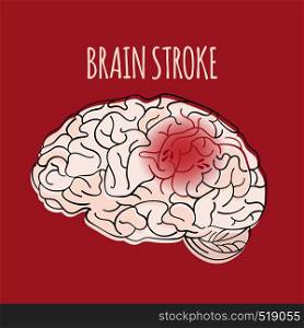 BRAIN STROKE Insult Medicine Health Vector Illustration