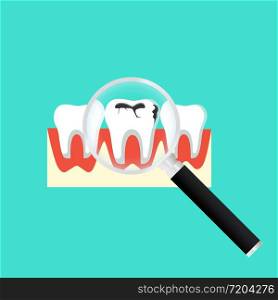 Caries dental problems. Tooth with caries icon with magnifier. Big hole in the human teeth on isolated background. EPS 10 vector. Caries dental problems. Tooth with caries icon with magnifier. Big hole in the human teeth on isolated background. EPS 10 vector.