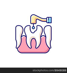 Caries treatment RGB color icon. Tooth recovery stomatology technics. Painless dental treatment. Professional dental care. Crown restoration. Endodontic root canal. Isolated vector illustration. Caries treatment RGB color icon