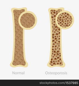 Cartoon human osteoporosis and normal healthy bone vector flat illustration. Sponge structure of disease person anatomy and health skeletal isolated on white. Orthopedic illness problem. Cartoon human osteoporosis and normal healthy bone vector flat illustration