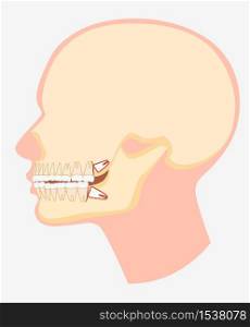 Cartoon model of human dental jaw side view vector flat illustration. Skull image with wisdom tooth pushing adjacent teeth isolated on white background. Dentistry surgery problem. Cartoon model of human dental jaw side view vector flat illustration