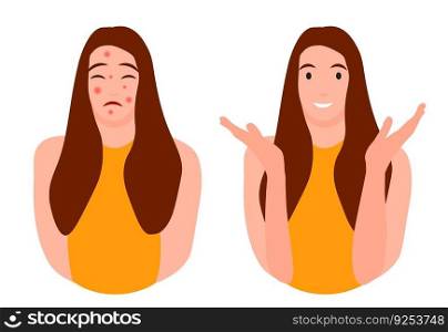 Cartoon teenage girl character with and without acne. Skin problems concept. Colorful vector illustration isolated on white background. Medicine, beauty and health care.