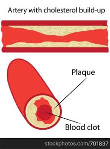 cholesterol plaque in artery vessels vector illustration