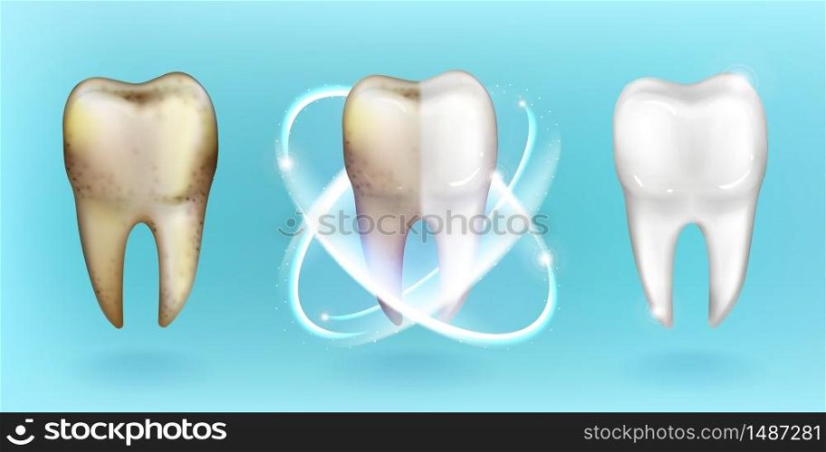 Clean and dirty tooth, whitening and clearing teeth process. Dental and oral cavity health care, enamel restoration, toothpaste advertising isolated on blue background Realistic 3d vector illustration. Clean and dirty tooth, whitening or clearing teeth