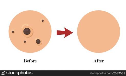 close up skin, blackhead pimples acne type face pore.skincare problems concept.befire after flat vector illustration.