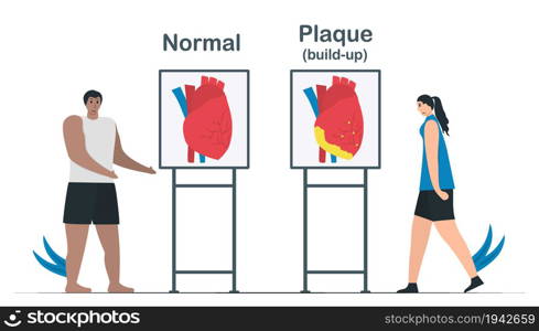 Comparison of normal heart and coronary artery disease. Plaque buildup can creat of deposits of cholesterol in the artery. Cardiology vector illustration isolated on white background.