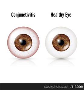 Conjunctivitis. Red Eye. Healthy Eye. Conjunctivitis. Red Eye. Healthy Eye And Eyeball with Conjunctivitis. Vector