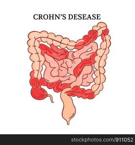 CROHN DESEASE Intestines Medicine Anatomy Vector Illustration