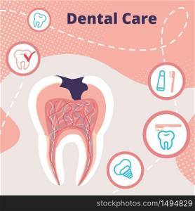 Dental Care Infographics Banner with Teeth Problems. Cross Section of Tooth with Caries Hole and Nerves. Stomatology Icons Background. Toothpaste, Brush, Implant. Cartoon Flat Vector Illustration. Dental Care Infographics Banner with Teeth Problem