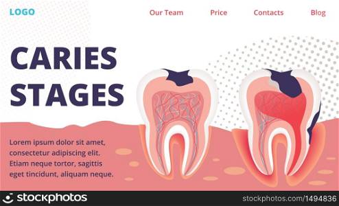 Dental Clinic, Stomatology Innovative Technology for Caries Treatment Medical Startup Trendy Flat Vector Vector Web Banner, Landing Page Template. Teeth with Damaged Enamel Cross Section Illustration