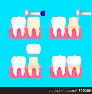 Dental crown installation process. Dental care concept. Illustration isolated on blue background.
