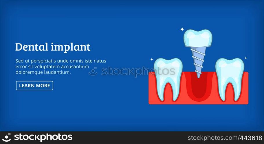 Dental implant horizontal concept. Cartoon illustration of dental implant banner horizontal vector for web. Dental implant banner horizontal, cartoon style