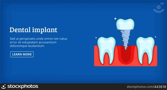 Dental implant horizontal concept. Cartoon illustration of dental implant banner horizontal vector for web. Dental implant banner horizontal, cartoon style