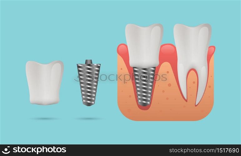 Dental implant structure, human teeth and dental implant, vector illustration