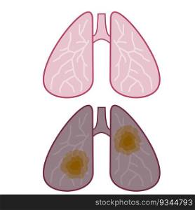 Dirty lung with brown spots from Smoking. The internal organ of a person with a dissatisfied face. Health and breathing problems. Sick person. Medical care. Cartoon flat illustration. Dirty lung with brown spots from Smoking.