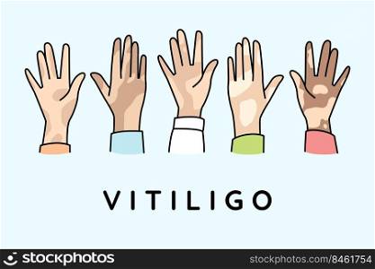 Diverse hands of people suffer from vitiligo disease. People struggle with pigmentation on body. World vitiligo day concept. Vector illustration.. People hands with vitiligo