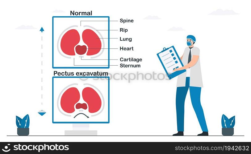Doctor checks a pectus excavatum that is a structural deformity of anterior thoracic wall. Sternum and rib cage are shaped abnormally. Pulmonology vector illustration about restrictive lung disease.