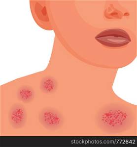 Eczema affected a body Dermatology skin disease concept vector illustration on a white background isolated