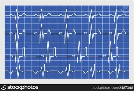 Electrocardiogram scan result vector concept. EKG monitor for emergency. Cardiac test illustration. Heart beat on paper.. Electrocardiogram scan result vector concept. EKG monitor for emergency. Cardiac test illustration. Heart beat