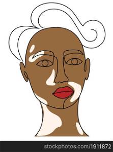 Face of a black man with vitiligo line art. Female or male portrait with pigmented white spots. Autoimmune skin disease, vector illustration.. Face of a black man with vitiligo line art.