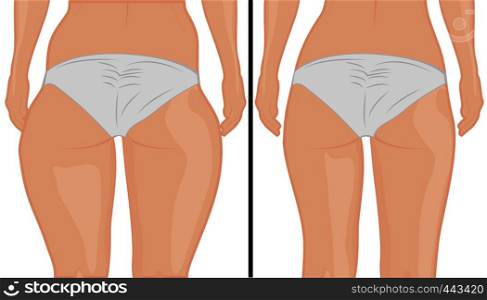 Fat and slim girl's back. Fat thig. Liposuction. Before and after. Woman body correction vector illustratio