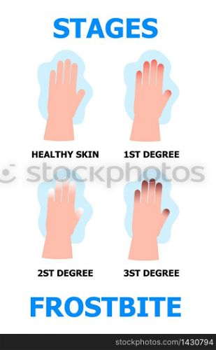 Frostbite stages info-graphic vector. Hypothermia in winter season. Problems with skin of frost fingers are shown.