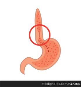 Gastroesophageal reflux desease. Gerd stomach vector illustration on a white background