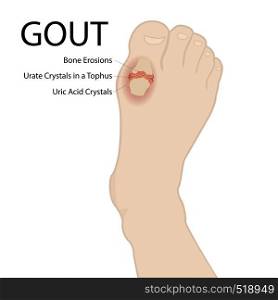 Gout arthritis. Human foot. Vector medical illustration on a white background