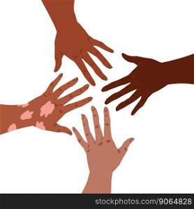 Group of hands reaching to each other, one hand with vitiligo patch