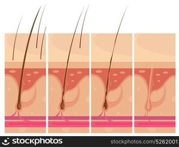 Hair Loss Skin Concept. Hair loss storyboard conceptual compositions set with profile macro view of balding scalp skin infographic images vector illustration