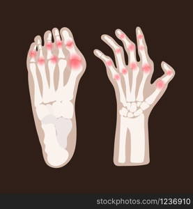 HAND LEG ARTHRITIS Rheumatoid Medicine Education Vector Scheme