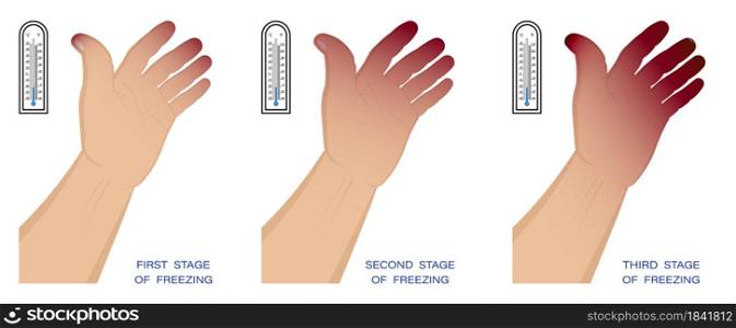 hand of man with different stages of frostbite. Freezing and skin damage in winter in cold air. First aid for hypothermia. Vector