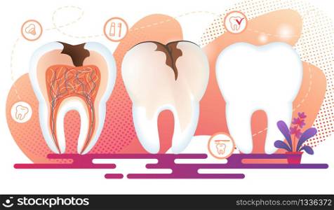 Healthy and Unhealthy Teeth Stand in Raw. Tooth Decay Cross Section with all Parts and Caries Hole. Dentistry Icons with Implantat, Toothpaste and Brush on White Background. Flat Vector Illustration. Healthy and Unhealthy Teeth Stand in Raw. Decay.